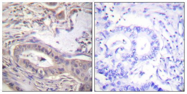 Immunohistochemistry analysis of paraffin-embedded human lung carcinoma, using BCL-XL (Phospho-Thr47) Antibody