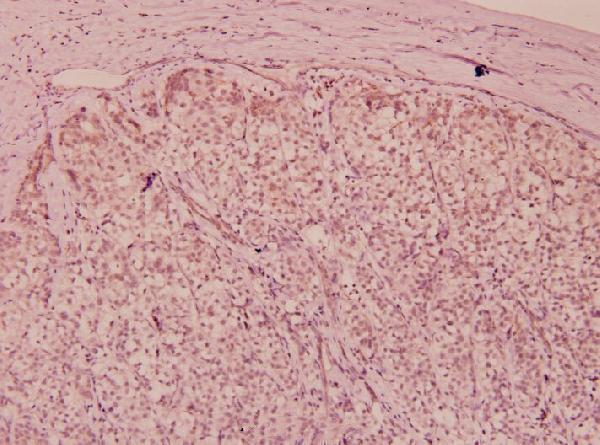 Immunohistochemistry (IHC) analyzes of p-Flt3 (Y591) pAb in paraffin-embedded human liver carcinoma tissue at 1:100