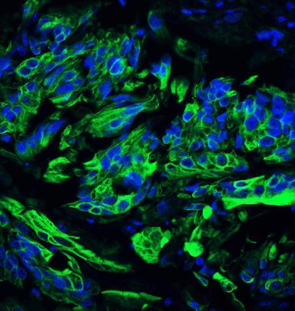 Immunofluorescence of TET2 in human colon carcinoma tissue with TET2 antibody at 20 μg/ml