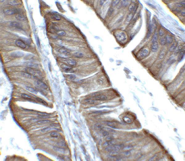 Immunohistochemistry of TET2 in human colon carcinoma tissue with TET2 antibody at 2 μg/ml