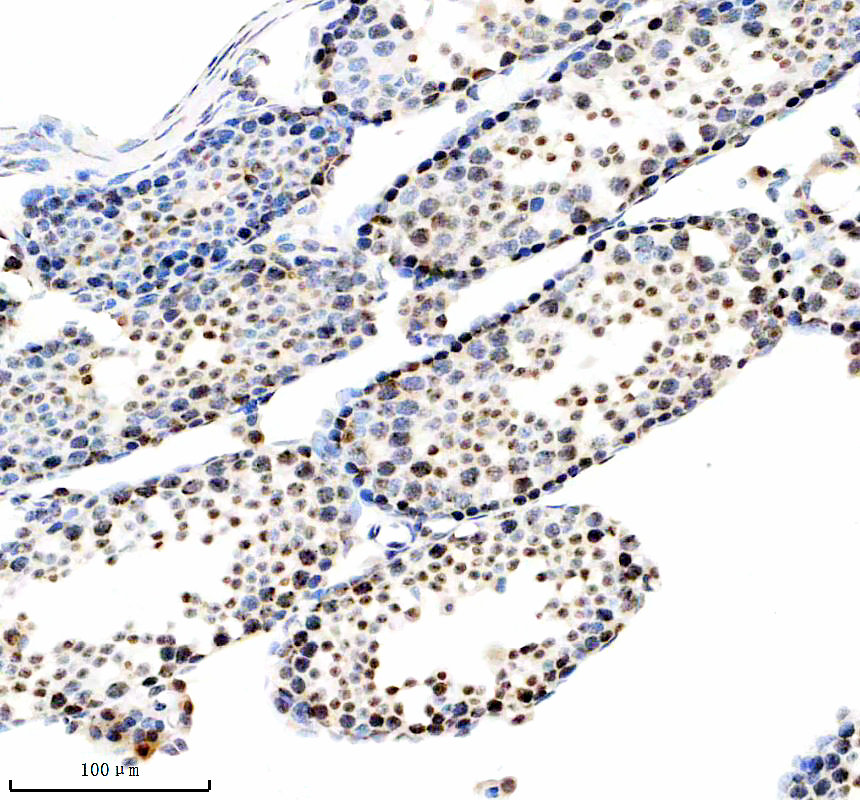 IHC analysis of WT1 using anti-WT1 antibody (A00199-2)