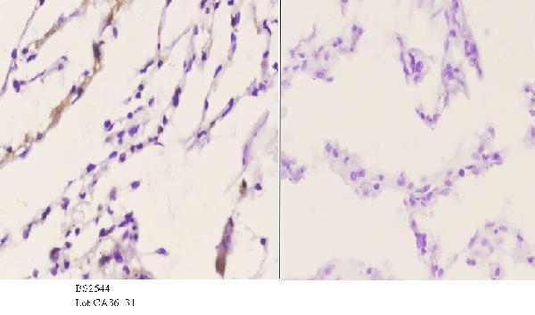 Immunohistochemistry (IHC) analyzes of CBP (E1528) pAb in paraffin-embedded human lung carcinoma tissue at 1:50
