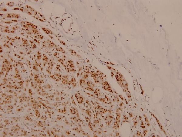 Immunohistochemistry (IHC) analyzes of Cdk1/Cdc2 (phospho-T161) polyclonal antibody in paraffin-embedded human breast carcinoma tissue at 1:100