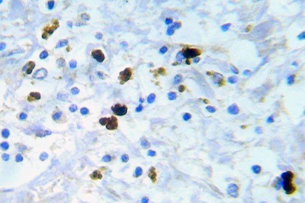 Immunohistochemistry (IHC) analyzes of p-Cdk1/Cdc2 (Y15) pAb in paraffin-embedded human breast carcinoma tissue