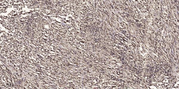 Immunohistochemical analysis of paraffin-embedded human small intestinal carcinoma tissue