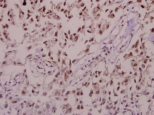 Immunohistochemistry (IHC) analyzes of p-Synuclein-α (S129) pAb in paraffin-embedded human colorectal carcinoma tissue at 1:50