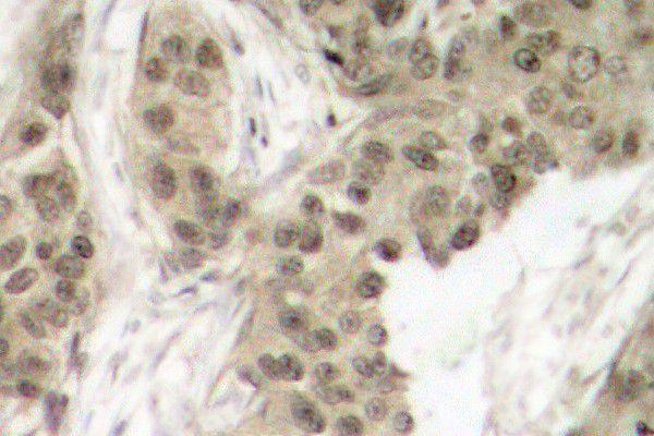 Immunohistochemistry (IHC) analyzes of p-Synuclein-α (Y133) pAb in paraffin-embedded human breast carcinoma
tissue