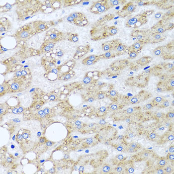 Immunohistochemistry of paraffin-embedded human liver injury using SRI antibody at dilution of 1:100 (x40 lens)