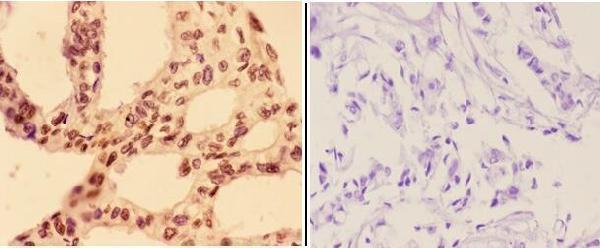 Immunohistochemistry (IHC) analyzes of AhR (phospho-S36) pAb in paraffin-embedded human breast carcinoma tissue at 1:50,showing cytoplasmic and nucleus staining