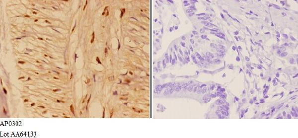 Immunohistochemistry (IHC) analyzes of AhR (phospho-S36) pAb in paraffin-embedded human colon carcinoma tissue at 1:50,showing cytoplasmic and nucleus staining