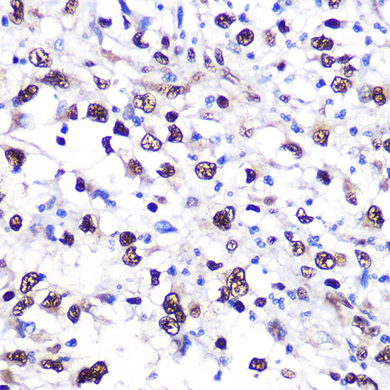Immunohistochemistry of paraffin-embedded human liver cancer using NCL Rabbit pAb  at dilution of 1:100 