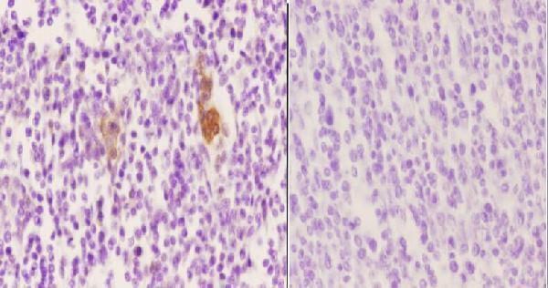 Immunohistochemistry (IHC) analyzes of p-Vimentin (S56) pAb in paraffin-embedded human tonsil carcinoma tissue at 1:50