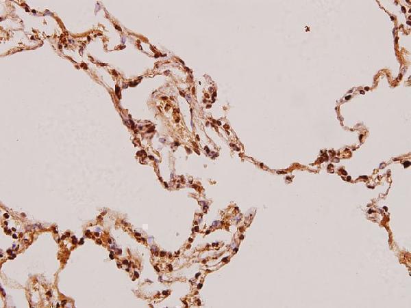 Immunohistochemistry (IHC) analyzes of FADD (N188) pAb in paraffin-embedded human lung carcinoma tissue at 1:100