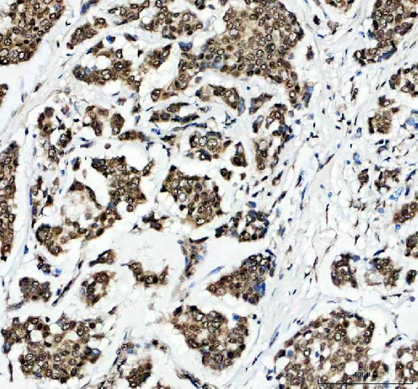 Figure 2. IHC analysis of H2AFX using anti-H2AFX antibody (A00241-1). H2AFX was detected in a paraffin-embedded section of human breast cancer tissue. Heat mediated antigen retrieval was performed in EDTA buffer (pH 8.0, epitope retrieval solution). The tissue section was blocked with 10% goat serum. The tissue section was then incubated with 2 microg/ml rabbit anti-H2AFX Antibody (A00241-1) overnight at 4°C. Peroxidase Conjugated Goat Anti-rabbit IgG was used as secondary antibody and incubated for 30 minutes at 37°C. The tissue section was developed using HRP Conjugated Rabbit IgG Super Vision Assay Kit (Catalog # SV0002) with DAB as the chromogen.