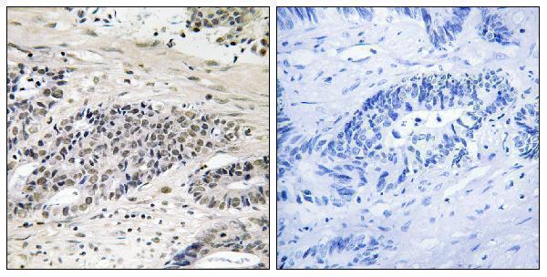 Immunohistochemistry analysis of paraffin-embedded human colon carcinoma, using AurA (Phospho-Ser342) Antibody
