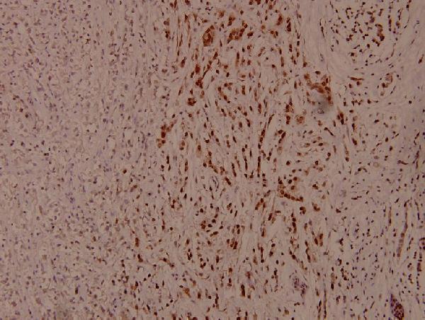 Immunohistochemistry (IHC) analyzes of p-AURKA (T288) pAb in paraffin-embedded human breast carcinoma tissue at 1:100