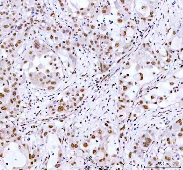  IHC analysis of ARID1A using anti-ARID1A antibody (A00247-2)
