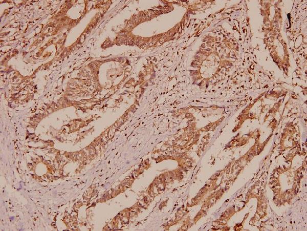 Immunohistochemistry (IHC) analyzes of EMMPRIN (Q370) pAb in paraffin-embedded human colorectal carcinoma tissue at 1:50
