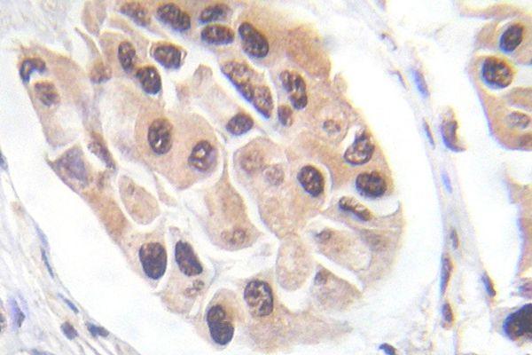 Immunohistochemistry (IHC) analyzes of p-FOXO3A (S253) pAb in paraffin-embedded human breast carcinoma tissue