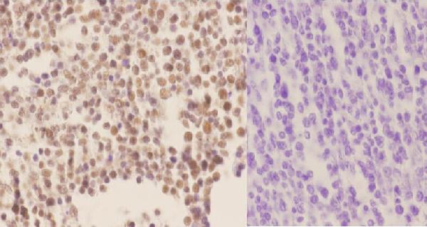 Immunohistochemistry (IHC) analyzes of p-HDAC1 (S421) pAb in paraffin-embedded human tonsil carcinoma tissue at 1:50