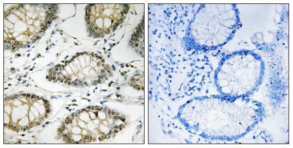 Immunohistochemistry analysis of paraffin-embedded human colon carcinoma, using ATR (Phospho-Ser428) Antibody