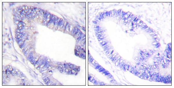 Immunohistochemistry analysis of paraffin-embedded human colon carcinoma, using IRS-1 (Phospho-Ser1101) Antibody