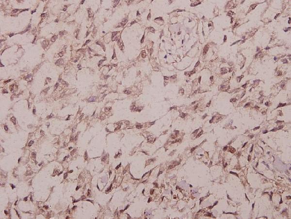 Immunohistochemistry (IHC) analyzes of P-IRS-1 (S1101) pAb in paraffin-embedded human colorectal carcinoma tissue at 1:50