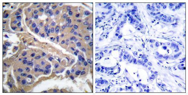 Immunohistochemistry analysis of paraffin-embedded human breast cancer, using IRS-1 (Phospho-Ser307) Antibody