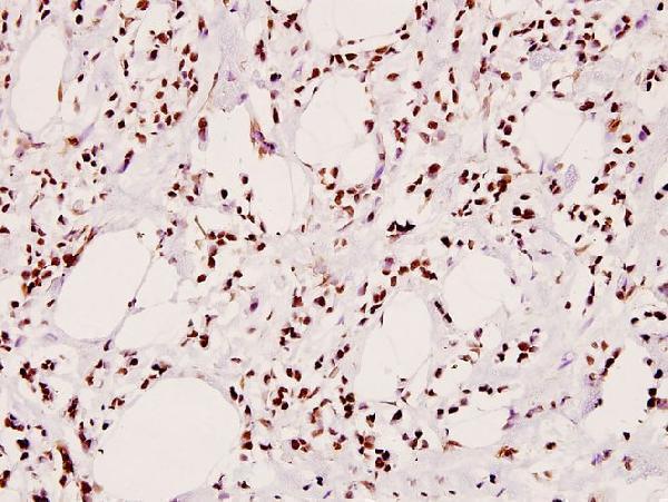 Immunohistochemistry (IHC) analyzes of p-IRS-1 (S307) pAb in paraffin-embedded human breast carcinoma tissue at 1:100