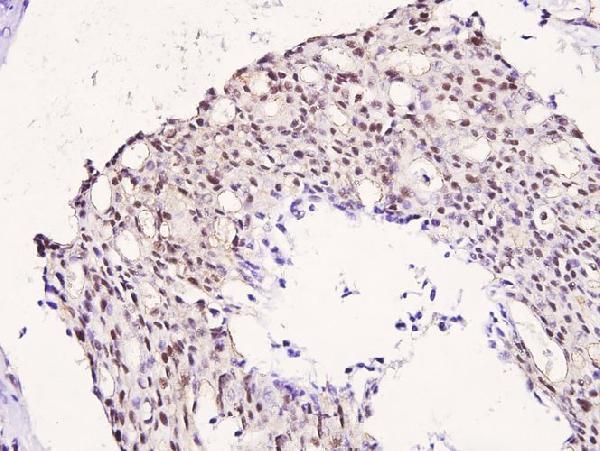 Immunohistochemistry (IHC) analyzes of p-IRS-1 (S323) pAb in paraffin-embedded human breast carcinoma tissue at 1:100