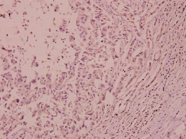 Immunohistochemistry (IHC) analyzes of p-IRS-1 (Y612) pAb in paraffin-embedded human breast carcinoma tissue at 1:100