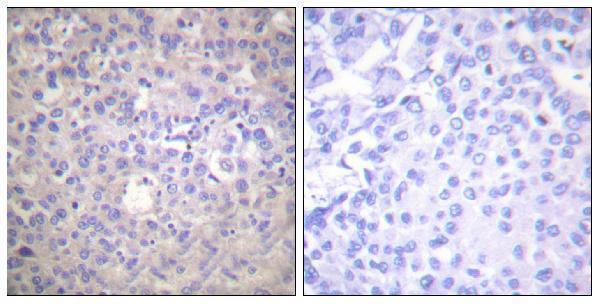 Immunohistochemistry analysis of paraffin-embedded human breast carcinoma, using IRS-1 (Phospho-Ser612) Antibody