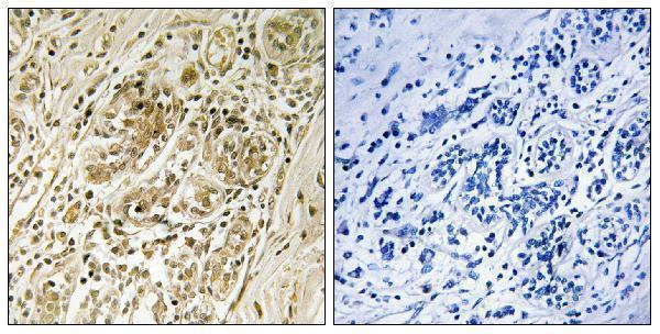 Immunohistochemistry analysis of paraffin-embedded human breast carcinoma, using IRS-1 (Phospho-Ser639) Antibody