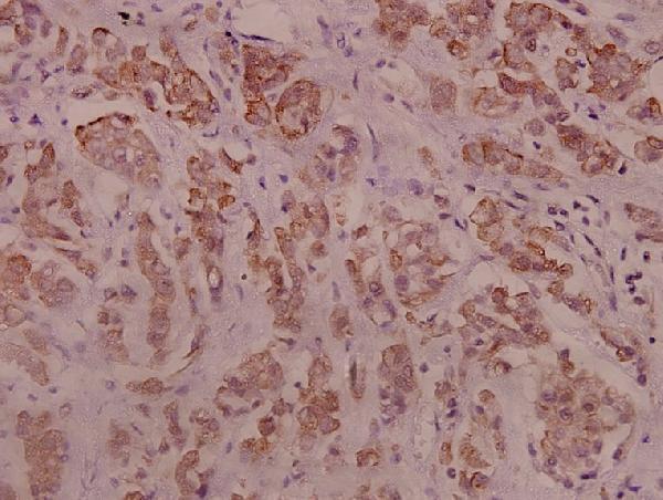 Immunohistochemistry (IHC) analyzes of p-IRS-1 (S794) pAb in paraffin-embedded human breast carcinoma tissue at 1:100