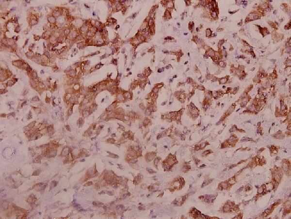 Immunohistochemistry (IHC) analyzes of IRS-1 (Y632) pAb in paraffin-embedded human breast carcinoma tissue at 1:100