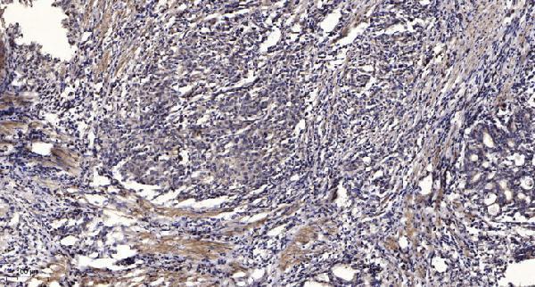Immunohistochemical analysis of paraffin-embedded human Gastric adenocarcinoma