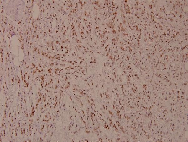 Immunohistochemistry (IHC) analyzes of p-MITF (S180) pAb in paraffin-embedded human breast carcinoma tissue at 1:100