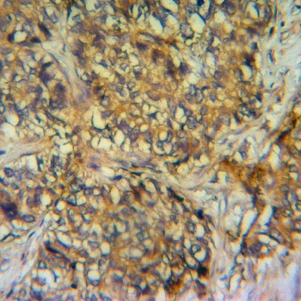 Immunohistochemistry (IHC) analyzes of VWF pAb in paraffin-embedded human colon carcinoma tissue at 1:50,showing cytoplasm staining