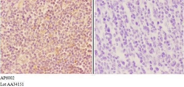 Immunohistochemistry (IHC) analyzes of VWF pAb in paraffin-embedded human tonsil carcinoma tissue at 1:50,showing cytoplasm staining