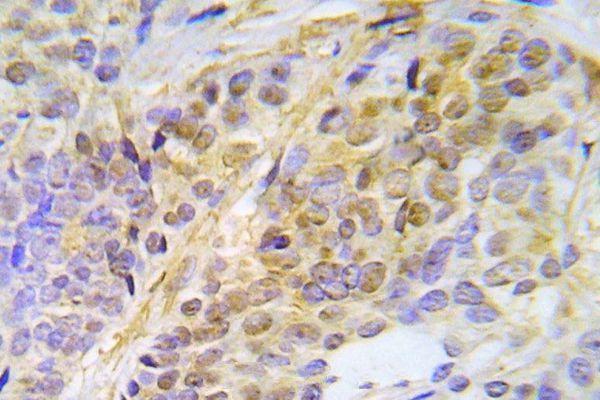 Immunohistochemistry (IHC) analyzes of p-CHK2 (T387) pAb in paraffin-embedded human lung adenocarcinoma tissue