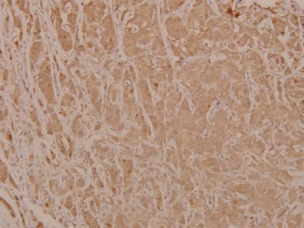 Immunohistochemistry (IHC) analyzes of p-Chk2 (T68) pAb in paraffin-embedded human breast carcinoma tissue at 1:100