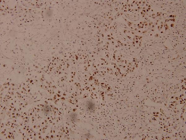 Immunohistochemistry (IHC) analyzes of p-NFκB-p105/p50 (S337) pAb in paraffin-embedded human breast carcinoma tissue at 1:100