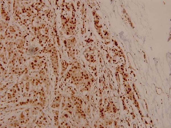 Immunohistochemistry (IHC) analyzes of p-NFkB-p105/p50 (S337) pAb in paraffin-embedded human breast carcinoma tissue at 1:100