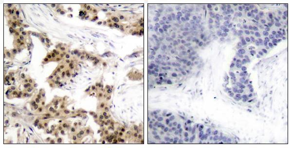 Immunohistochemistry analysis of paraffin-embedded human breast carcinoma, using NF-kappaB p105/p50 (Phospho-Ser893) Antibody