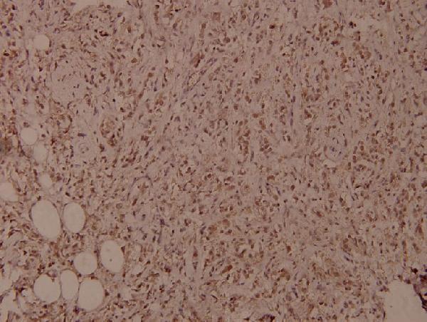 Immunohistochemistry (IHC) analyzes of p-NFkB-p105 (S927) pAb in paraffin-embedded human breast carcinoma tissue at 1:100