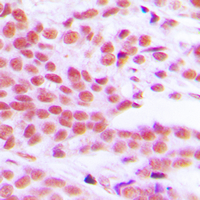 Immunohistochemical analysis of NF-kappaB p65 (pS529) staining in human breast cancer formalin fixed paraffin embedded tissue section