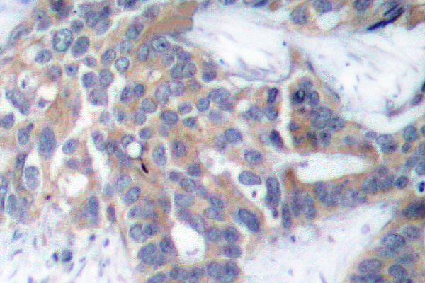 Immunohistochemistry (IHC) analyzes of p-MEK1/2 (S218/222) pAb in paraffin-embedded human breast carcinoma tissue