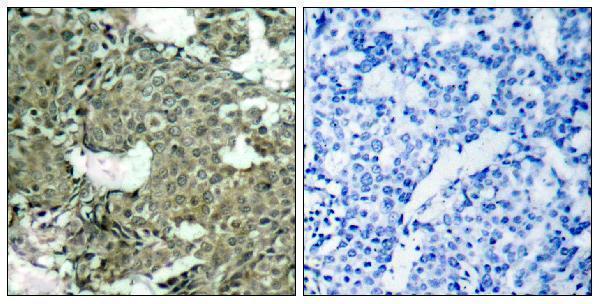 Immunohistochemistry analysis of paraffin-embedded human breast carcinoma, using MEK1/2 (Phospho-Ser221) Antibody