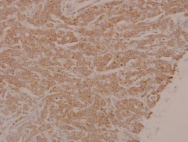 Immunohistochemistry (IHC) analyzes of p-MEK1/2 (S222/226) pAb in paraffin-embedded human breast carcinoma tissue at 1:100