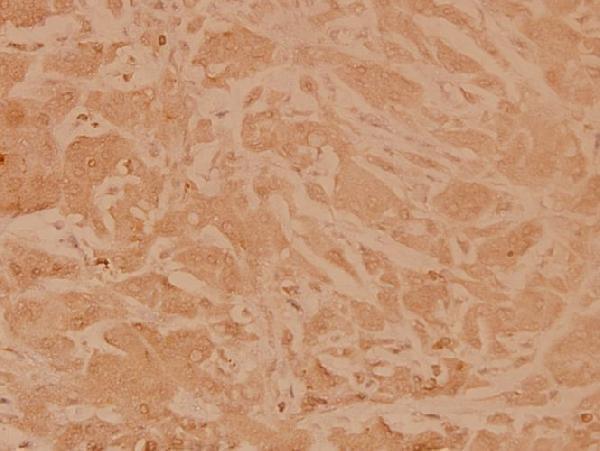 Immunohistochemistry (IHC) analyzes of MEK1 (T286) pAb in paraffin-embedded human breast carcinoma tissue at 1:100
